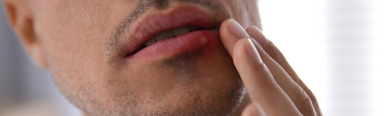 Kann Herpes von selbst wieder verschwinden?