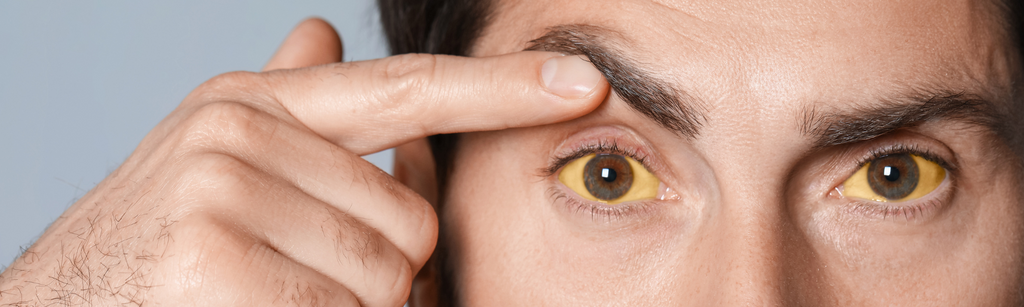 What is jaundice?