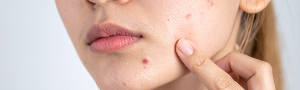 Hormonal acne: understanding and managing breakouts linked to hormones